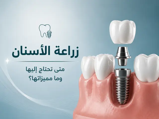زراعة الأسنان: متى تكون الحل الأفضل لتعويض الأسنان المفقودة؟