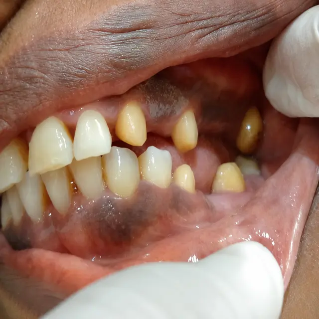 Before Missing Teeth Replacement & Smile Function Restoration