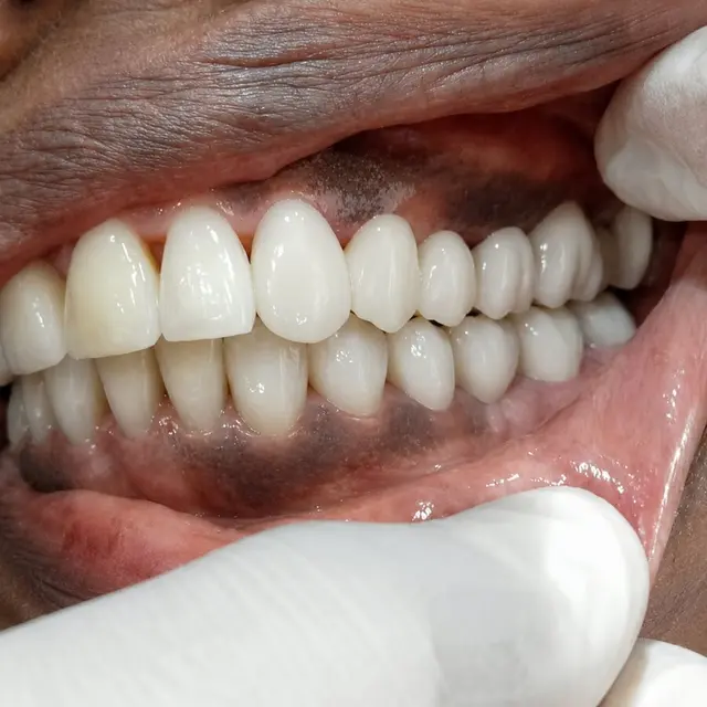 After Missing Teeth Replacement & Smile Function Restoration