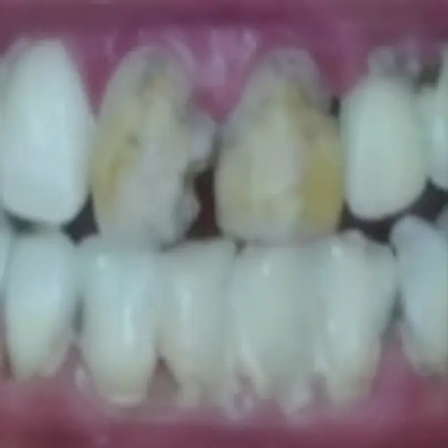 Before Front Teeth Enhancement for a More Balanced Smile