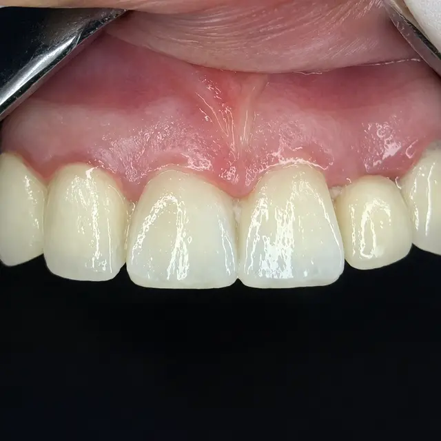 After Front Teeth Enhancement for a More Balanced Smile