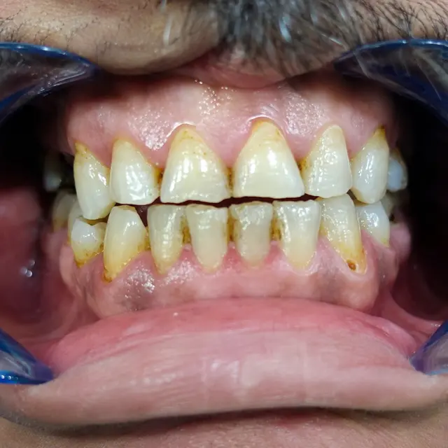 قبل علاج التصبغات وتحسين مظهر الابتسامة